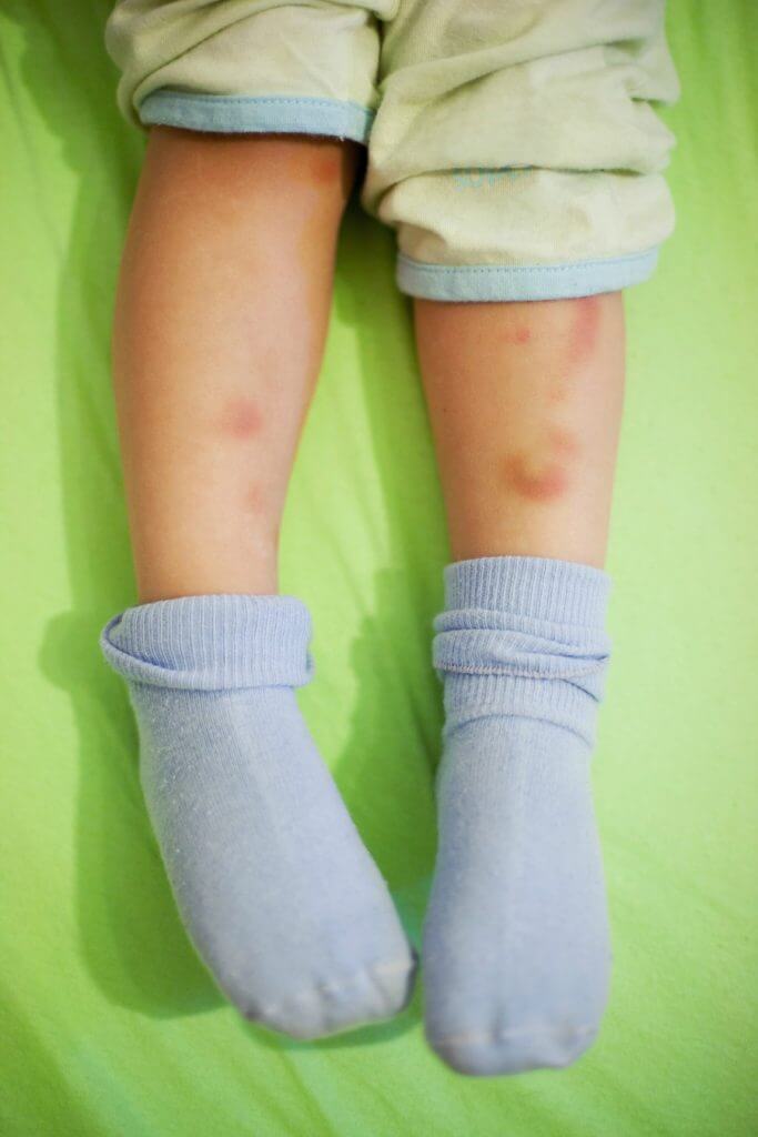 moretones-hijo-como-curo