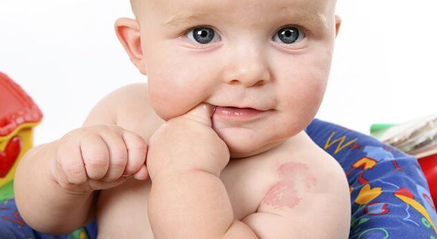 Tipos de marcas de nacimiento en bebés