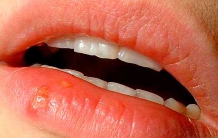 beso-herpes-bebe
