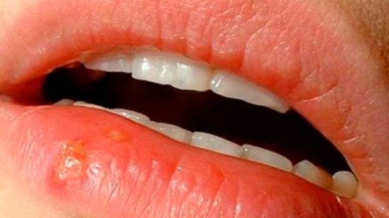beso-herpes-bebe