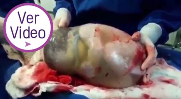 Hermoso video de bebé que nace en su saco amniótico