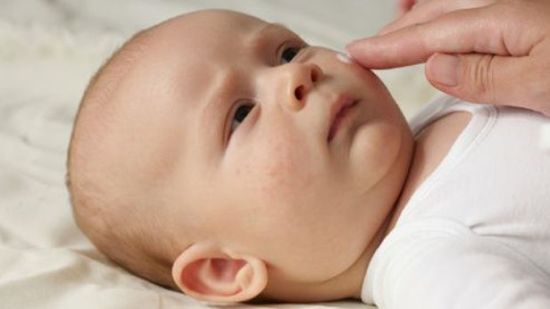 Eczema