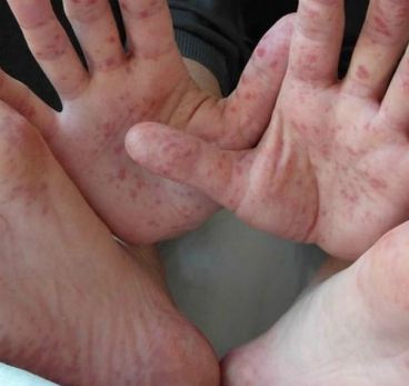 Virus pone en alerta a Hidalgo