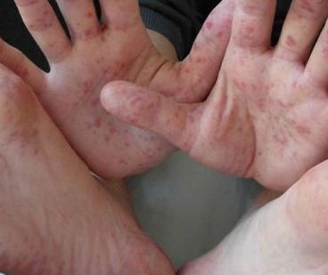 Virus pone en alerta a Hidalgo
