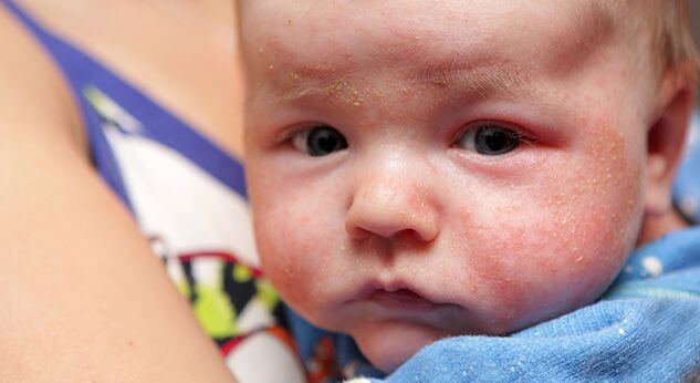 Psoriasis infantil: 15 datos que debes conocer