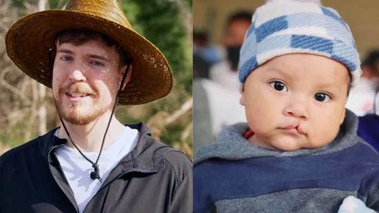 MrBeast regaló 100 cirugías a niños con labio leporino en México